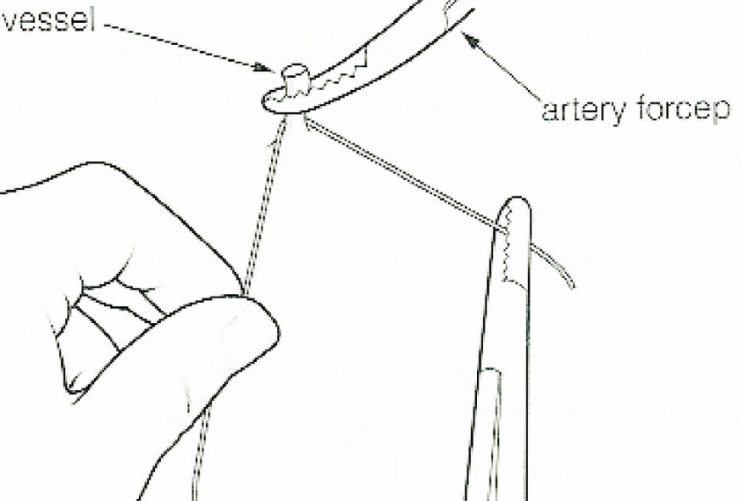 결찰(ligation)방법, suture tie, tie, stapling, clamp종류