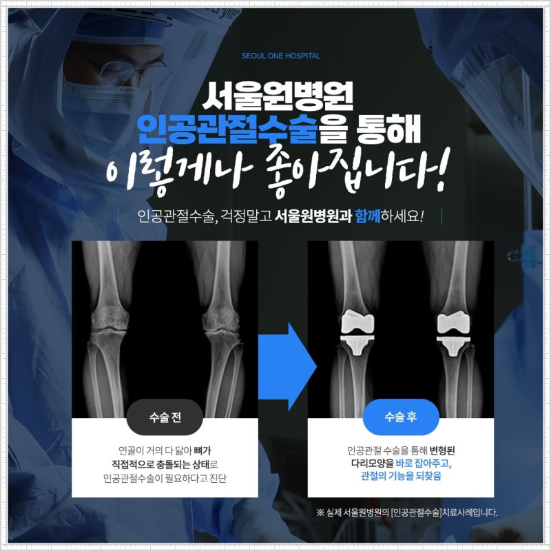 인공관절수술잘하는병원 선택이 고민돼요