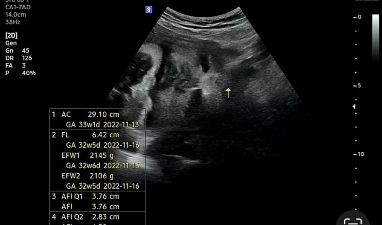 임신 34주차 2일 검진👼🏻 :: 막달검사 ( 심전도 검사, 흉부 x-ray, 혈액검사, 소변검사) , 34주 증상, 연세산후조리원 산전마사지