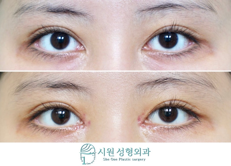 259 앞트임복원 (앞트임재건)