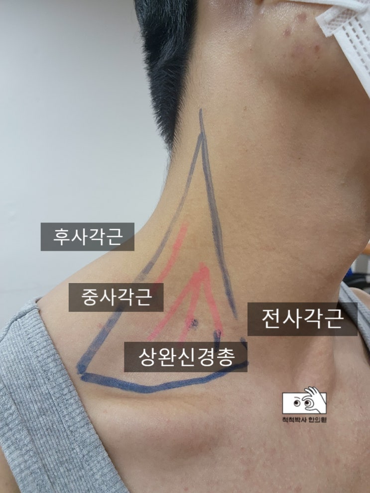  노량진 한의원 어깨 통증 테이핑 방법, 어깨충돌증후군 테이핑 붙이는 사진 + 사각근