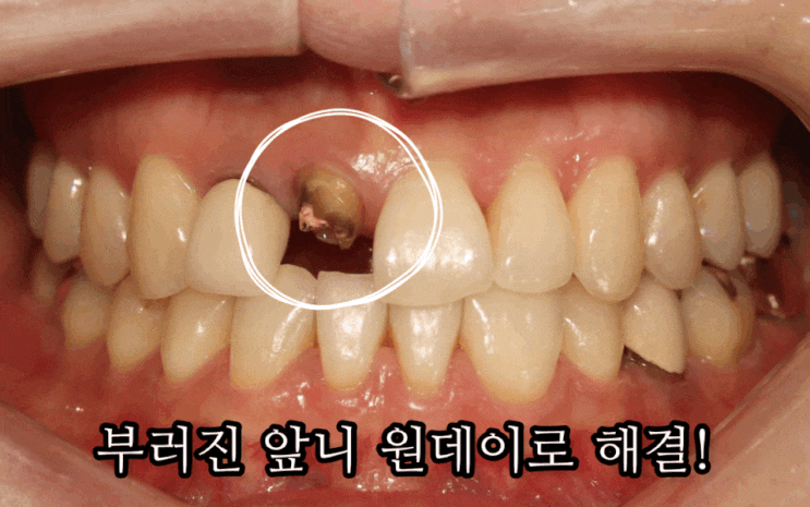  앞니 깨짐 부러짐 임플란트 원데이 치과 / 부러진 치아 치료 방법