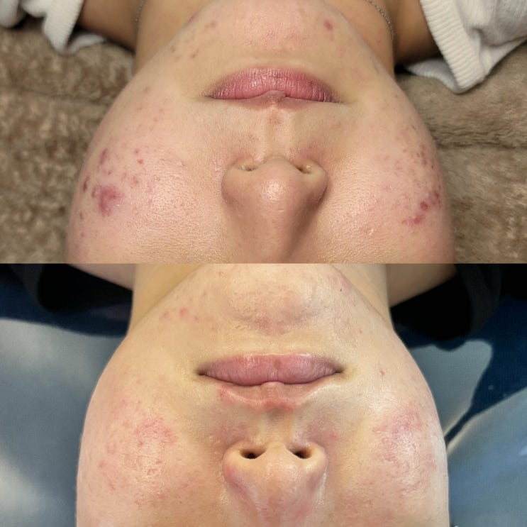  [제주피부관리/제주반듯]피부과/피부관리실 수천 수백만원 공중분해 되고 돌고 돌아 찾아오는 곳