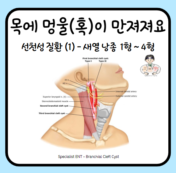  목에서 멍울이 만져져요 (2) - 선천성 경부 종물(Neck mass)과 양성종양 (1) : 새열낭종(Branchial Cleft Cyst, BCC) 1형 ~ 4형