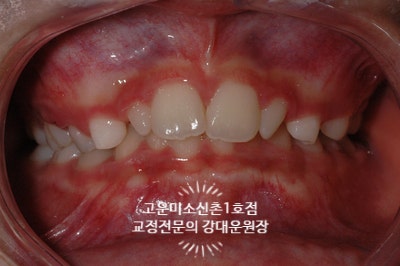  소아교정, 과개교합, 작은 앞니,2급부정교합 치료과정