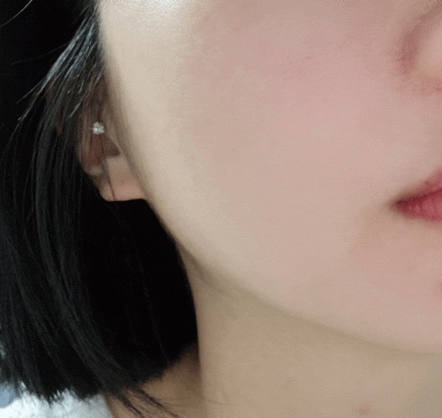  턱보톡스 이마주름보톡스 내돈내산 피부과시술 보톡스에대한 썰을풉니다 feat 신논현역피부과