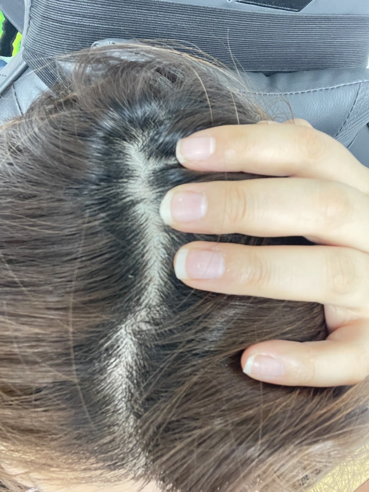  의정부 두피관리 탈모 고민 더아르디 두피 스케일링 후기
