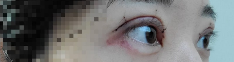 청담 비아이 쌍꺼풀 수술 후기, 부종완화/부종제거 한약 광교 서울한의원 추천[내돈내산] 5