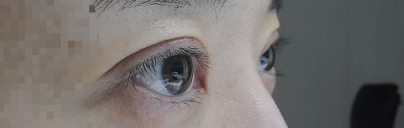 청담 비아이 쌍꺼풀 수술 후기, 부종완화/부종제거 한약 광교 서울한의원 추천[내돈내산] 2