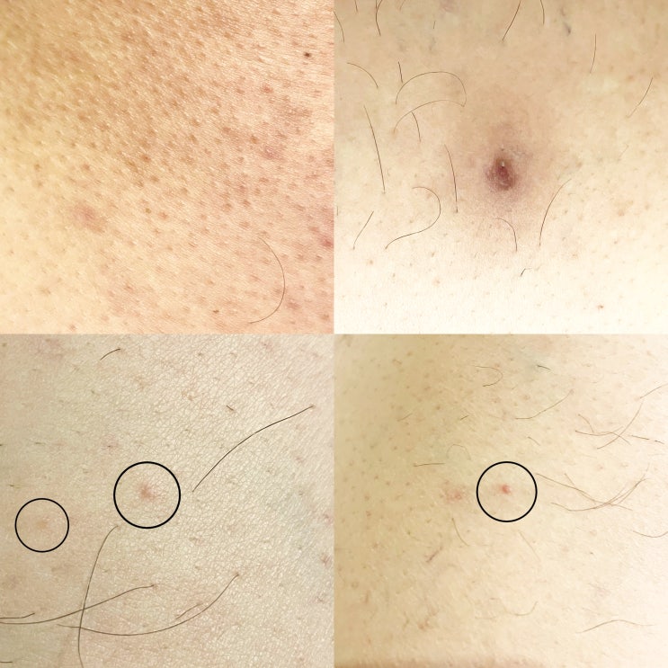 허벅지 여드름의 다양한 원인 정리 허벅지 여드름의 다양한 원인 정리