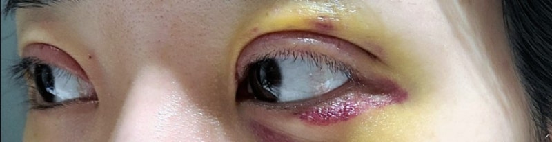 청담 비아이 쌍꺼풀 수술 후기, 부종완화/부종제거 한약 광교 서울한의원 추천[내돈내산] 3