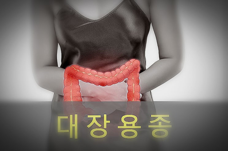  대장 용종, 대장암 원인과 증상, 예방, 좋은 음식