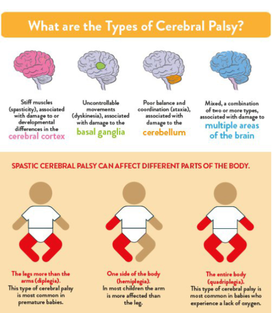 뇌성마비/정상발달 설명해주는 남자 - 뇌성마비(cerebral palsy)의 정의와 분류 및 특징