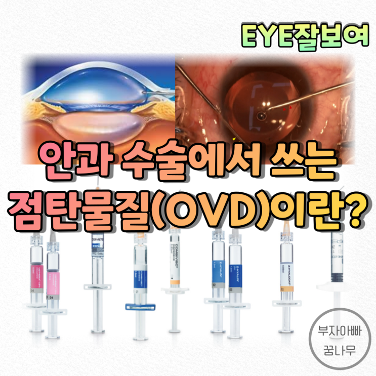  [EYE잘보여] 안과 수술에 사용되는 점탄물질(ViscoElastics, Ophthalmic Viscosurgical Devices; OVD) - 성분, 특성, 기능, 부작용