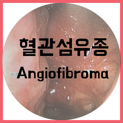  [코] 비강 혈관섬유종(Nasal Angiofibroma)
