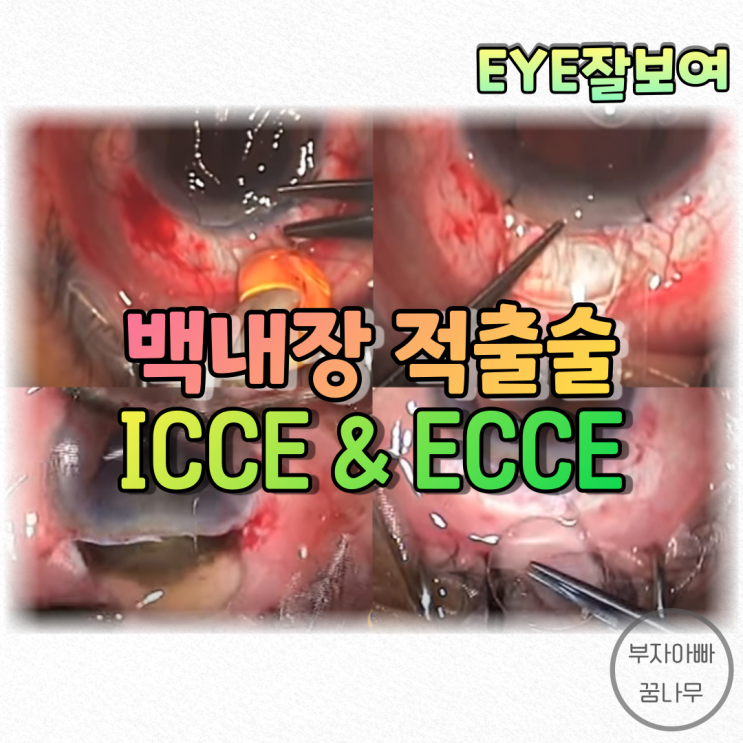  [EYE잘보여] 백내장수술 - 백내장적출술(Cataract Extraction), 이거 옛날거야? 요즘에도 쓴다던데?: ICCE, ECCE