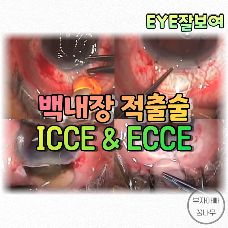 [EYE잘보여] 백내장수술 - 백내장적출술(Cataract Extraction), 이거 옛날거야? 요즘에도 쓴다던데?: ICCE, ECCE