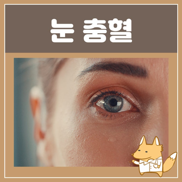  눈 실핏줄 터짐 결막하출혈 : 한쪽 눈 충혈 원인, 눈 따가움 간지러움, 왼쪽 오른쪽 눈 통증