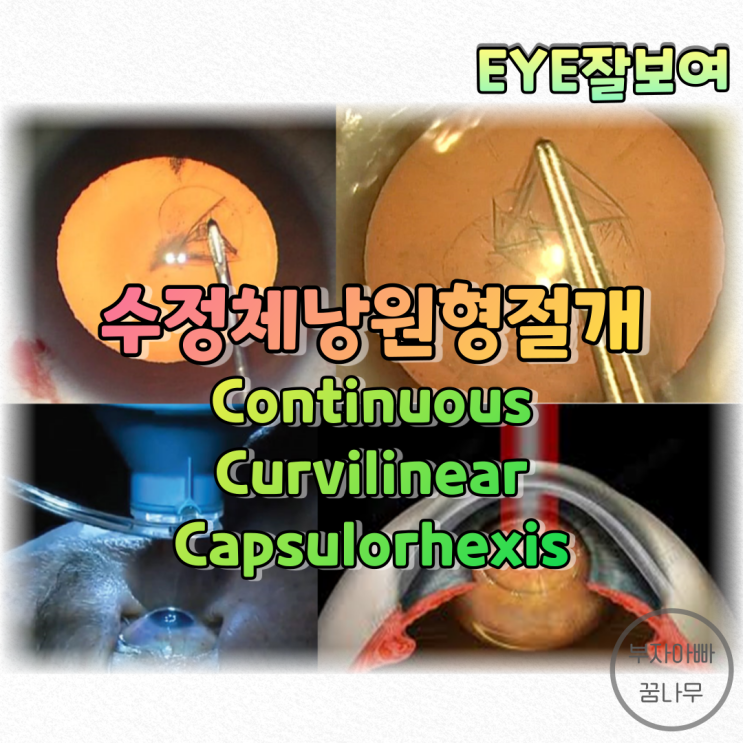  [EYE잘보여] 백내장수술 - 수정체낭원형절개(CCC), '레이저백내장수술'은 뭐야?
