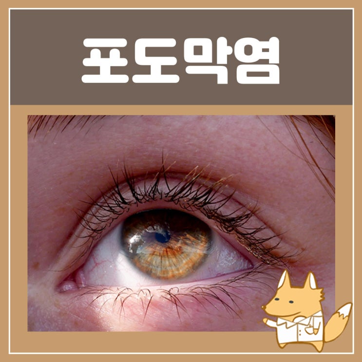  눈질환 포도막염 증상(홍채염) : 눈부심 현상, 시야 흐림, 안구통증 눈 건강 꾸준히 관리해야해요!