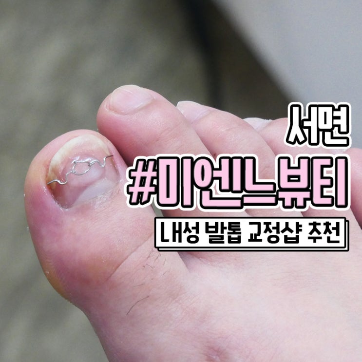  부산 서면내성발톱 교정 잘하는 미엔느뷰티