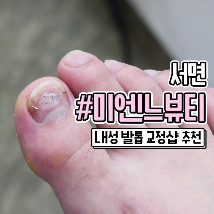 부산 서면내성발톱 교정 잘하는 미엔느뷰티