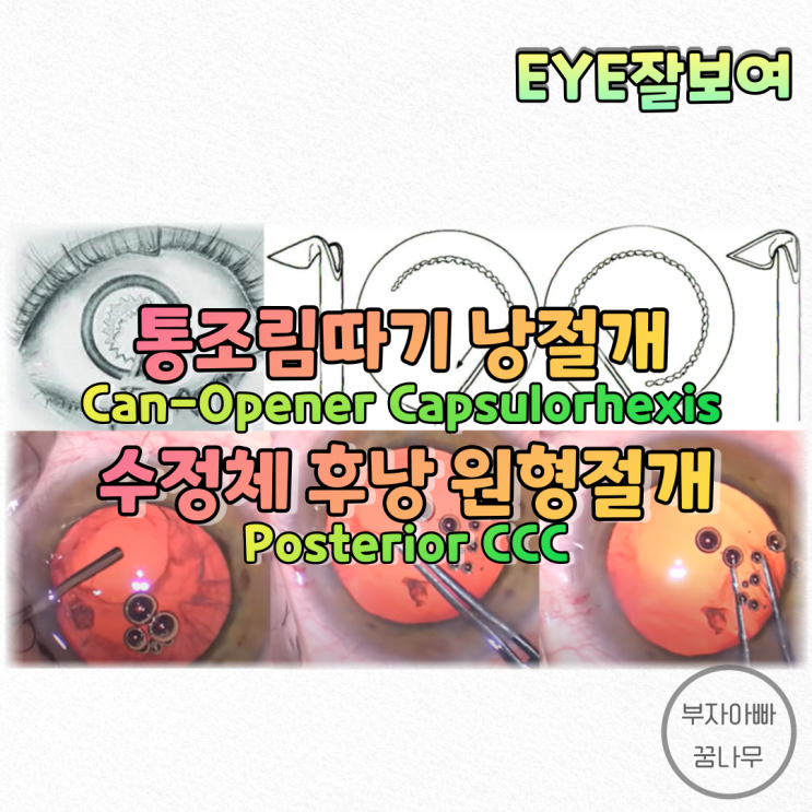 [EYE잘보여] 백내장수술 - 통조림따기 낭절개(Can Opener Capsulotomy), 후낭절개(Posetrior CCC; PCCC)