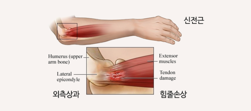 대구_팔꿈치