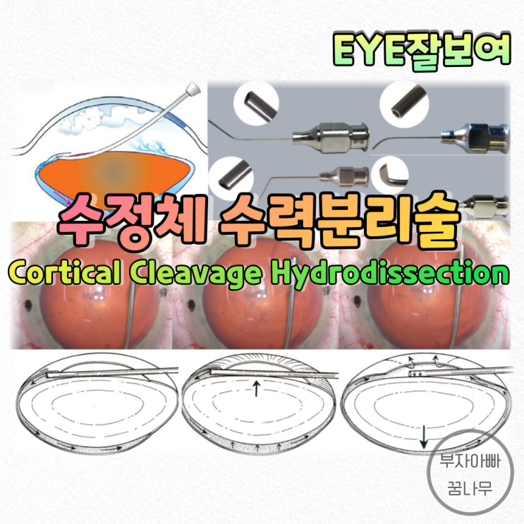  [EYE잘보여] 백내장수술 - 수력분리술(Hydrodissection, Cortical Cleavage Hydrodissection): 수정체에게 자유를 허락하노라?!