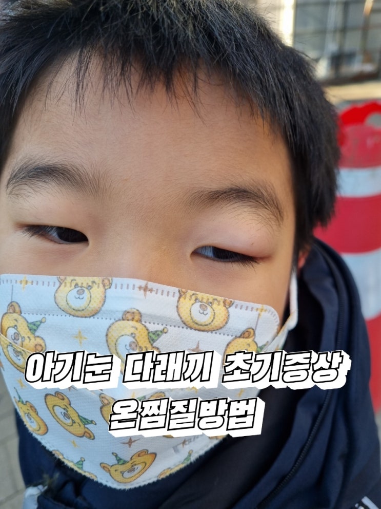  아기눈 다래끼 눈간지러움 붓기 초기증상 안과에 다녀왔어요