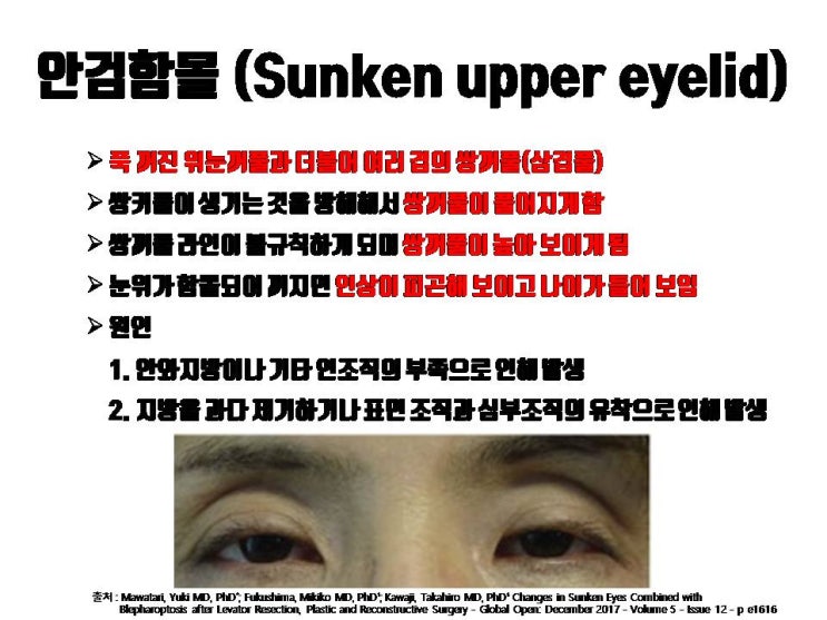  눈꺼풀 꺼짐 눈꺼풀 지방이식과 눈매교저으로 교정할 수 있어요!!!