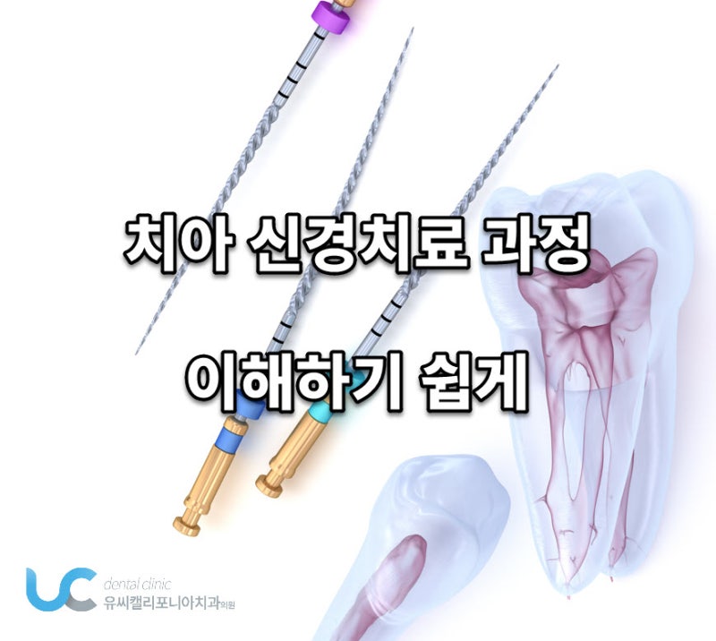 근관 치료에 대해 자세히 알아보기 4