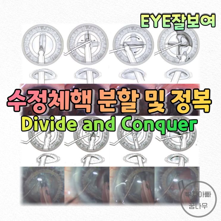  [EYE잘보여] 백내장수술 - 수정체핵 재배치술: 분할 및 정복술(Divide & Conquer; DC), Crater DC, Trench DC