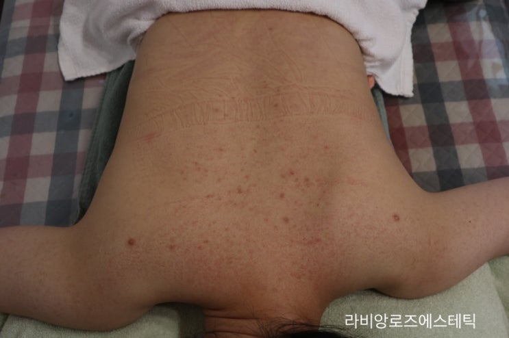  청량리피부관리 등여드름 없애는 법 (모공각화증, 등알라딘필링후기)