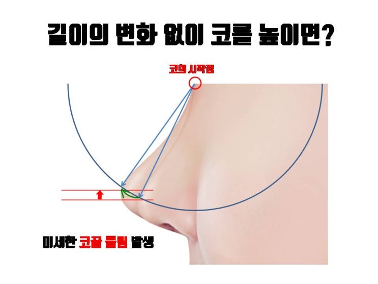  코수술로 코를 높이기만 하면 코끝이 들릴 수 있어요. 이를 예방하려면?