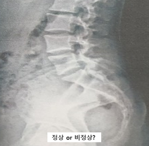  비정상이 정상인 것인가? 우리는 사람을 치료하는 것이지 SCANS 을 치료하는 것이 아니다(WE TREAT PEOPLE, NOT SCANS)-근거중심
