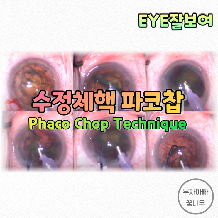  [EYE잘보여] 백내장수술 - 수정체핵 재배치술: 초음파 백내장 쪼개기(파코찹, Phaco Chop), 수정체핵유화술(Phacoemulsification)