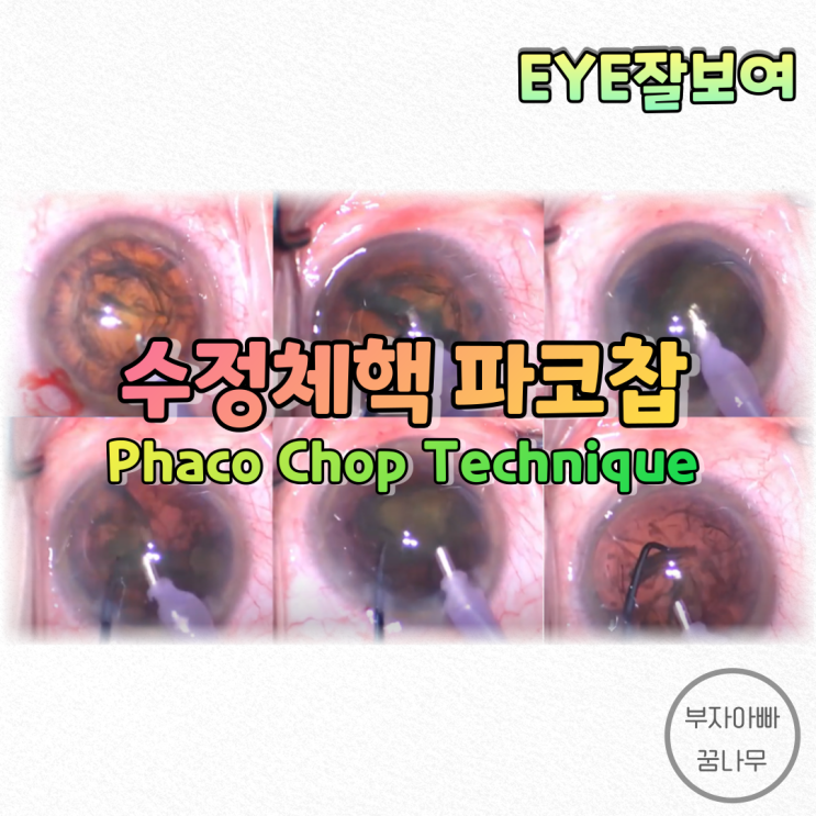 [EYE잘보여] 백내장수술 - 수정체핵 재배치술: 초음파 백내장 쪼개기(파코찹, Phaco Chop), 수정체핵유화술(Phacoemulsification)