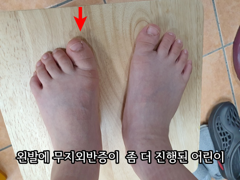 어린이 무지외반증 대책을 알려드려요