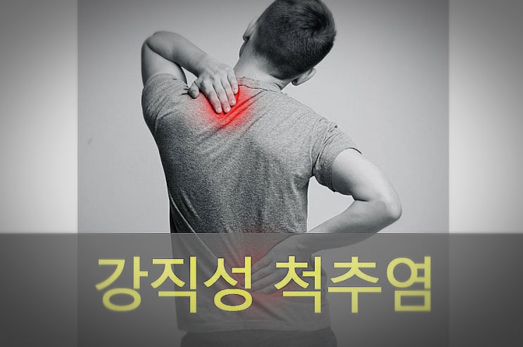  강직성 척추염( 척수염) 원인과 증상, 관리, 좋은 음식