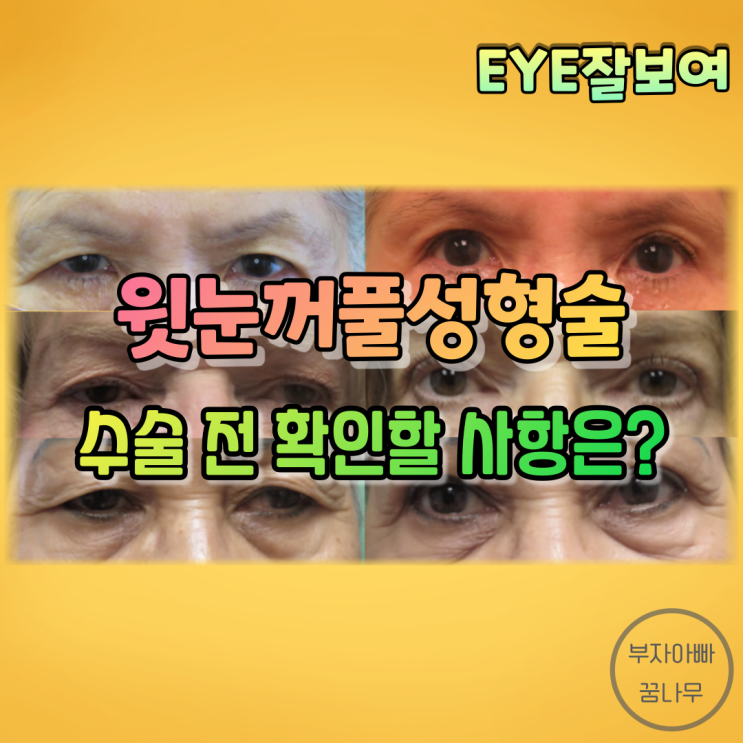[EYE잘보여] 윗눈꺼풀 성형술 - 수술 전에 확인해봐야 할 것들은?