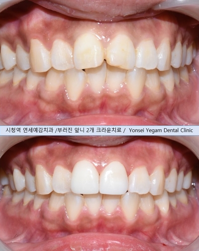  [시청역 치과]앞니가 튀어나왔어요&부러졌어요 ->앞니를 바르고 예쁘게,앞니 크라운