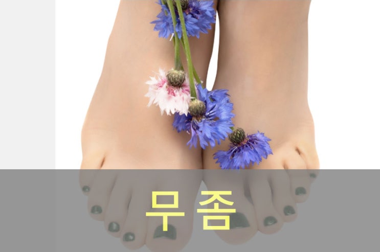  무좀 원인과 증상, 예방, 좋은 음식