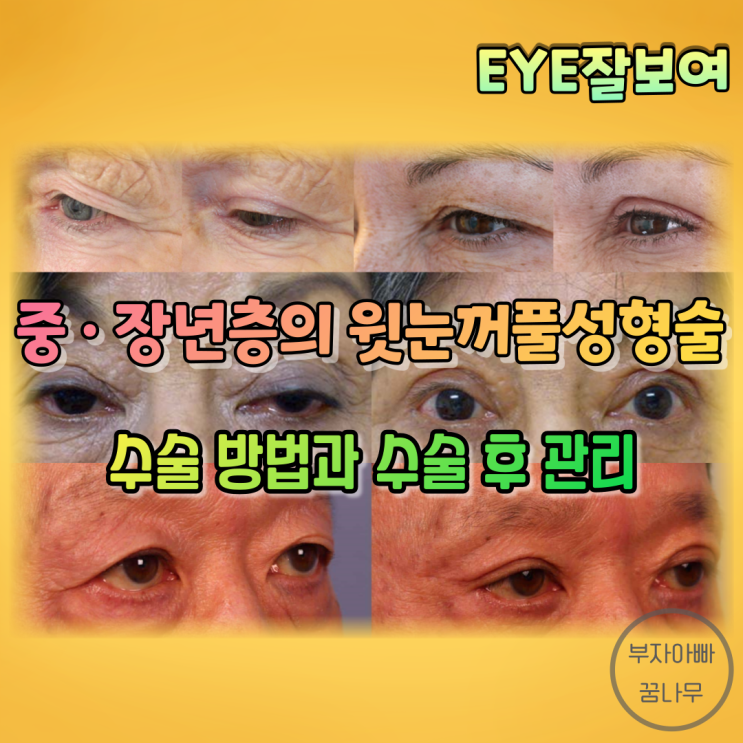  [EYE잘보여] 중년층&장년층의 윗눈꺼풀성형술 (1) - 수술 방법과 수술 후 관리