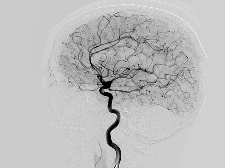 Cerebral Angiography 뇌혈관조영술 검사 준비, 방법, 주의사항, 부작용 (ft. 천자부위 관리 및 검사....