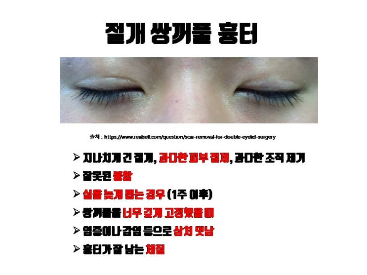  절개 쌍꺼풀 후 흉터로 고민이라면 쌍꺼풀 재수술로 개선할 수 있어요.