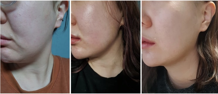  내 두번째 아빠 닥터케빈... 윤곽주사 교근축소 리터치 받고옴