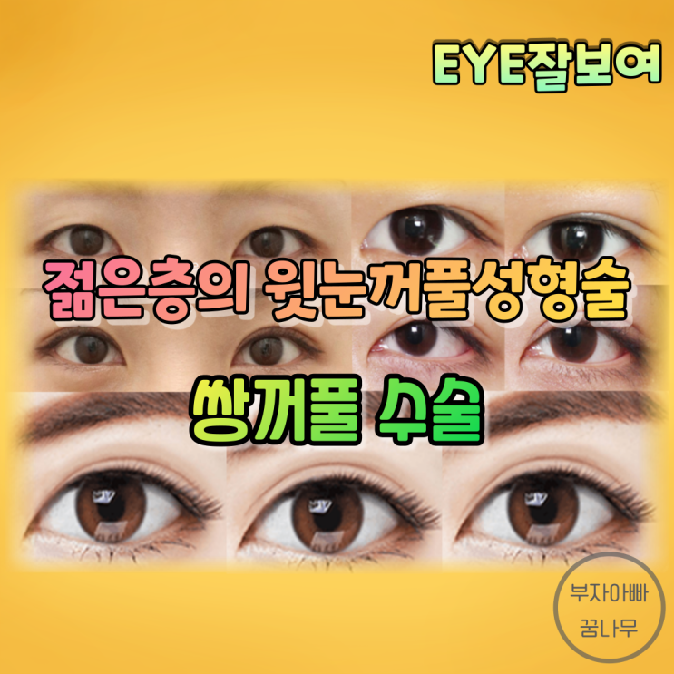  [EYE잘보여] 젊은 사람의 윗눈꺼풀성형술(쌍꺼풀수술) - 매몰법, 부분절개법, 절개법, Infold, Outfold, In-Outfold, 재수술, 합병증