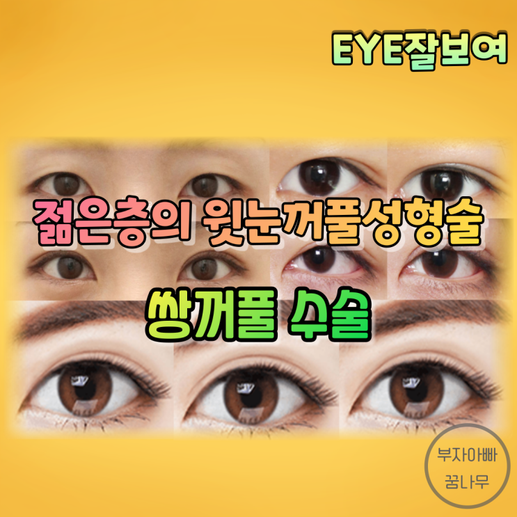 [EYE잘보여] 젊은 사람의 윗눈꺼풀성형술(쌍꺼풀수술) - 매몰법, 부분절개법, 절개법, Infold, Outfold, In-Outfold, 재수술, 합병증