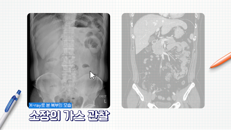 [CT vs MRI 완벽 정리] 영상의학과 전문의가 가르치는 CT와 MRI 검사 원리 [소요시간] 조영제 부작용? 5